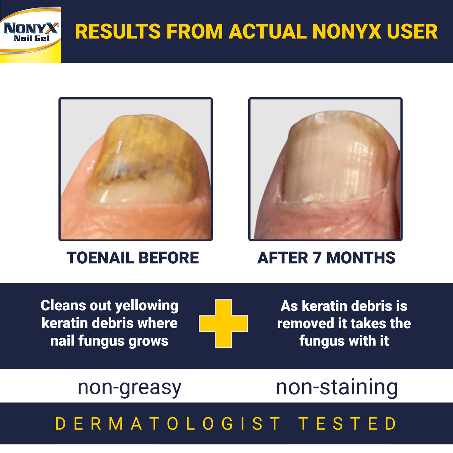 Nonyx Fungal Nail Clarifying Gel Clears Out Keratin Debris Where Nail Fungus Thrives 4 oz